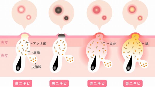 【ニキビ 治療 札幌】鍼灸はニキビに効果がありますか？