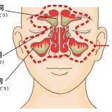 【蓄膿 治療 札幌】鼻づまり、お顔の痛みでお困りの方へ