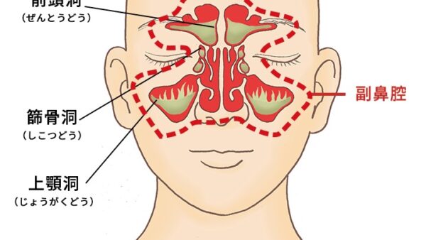 【蓄膿 治療 札幌】鼻づまり、お顔の痛みでお困りの方へ