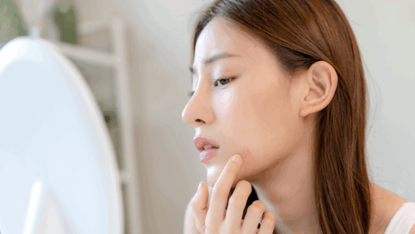 【肌荒れ 美容鍼 札幌】季節の変わり目「ゆらぎ肌」を整える秘訣とは？