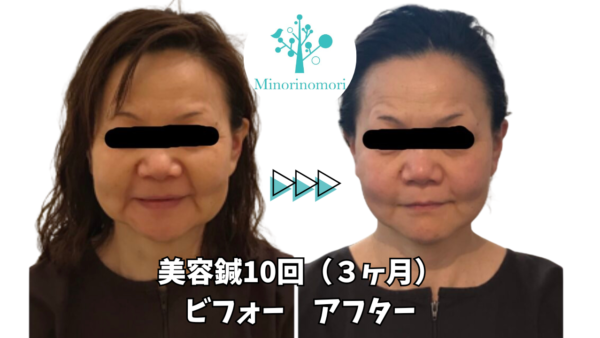 【美容鍼 効果 札幌】美容鍼、何回やったらいいの？