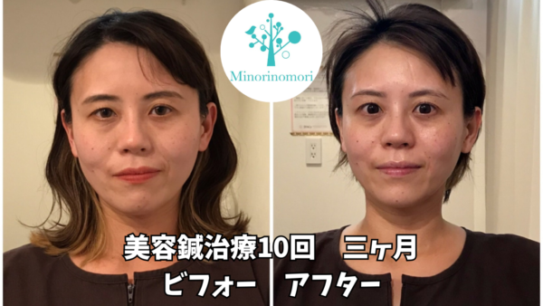 【小顔 エステ 札幌】美容鍼って痛い？