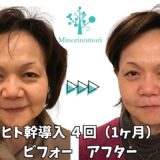 札幌 乾燥 肌荒れ　夏のダメージをリセットするには