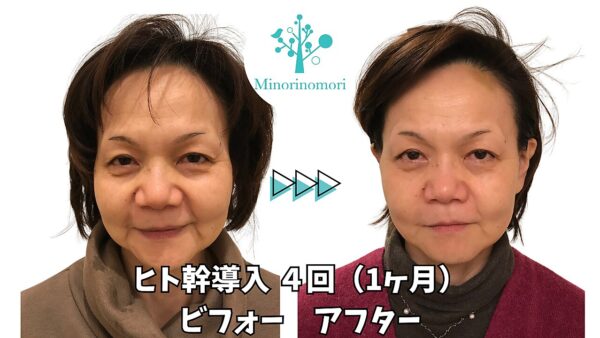 札幌 乾燥 肌荒れ　夏のダメージをリセットするには